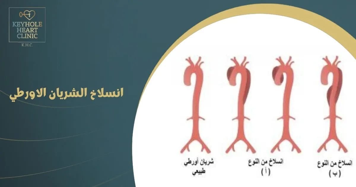 انسلاخ الشريان الاورطي