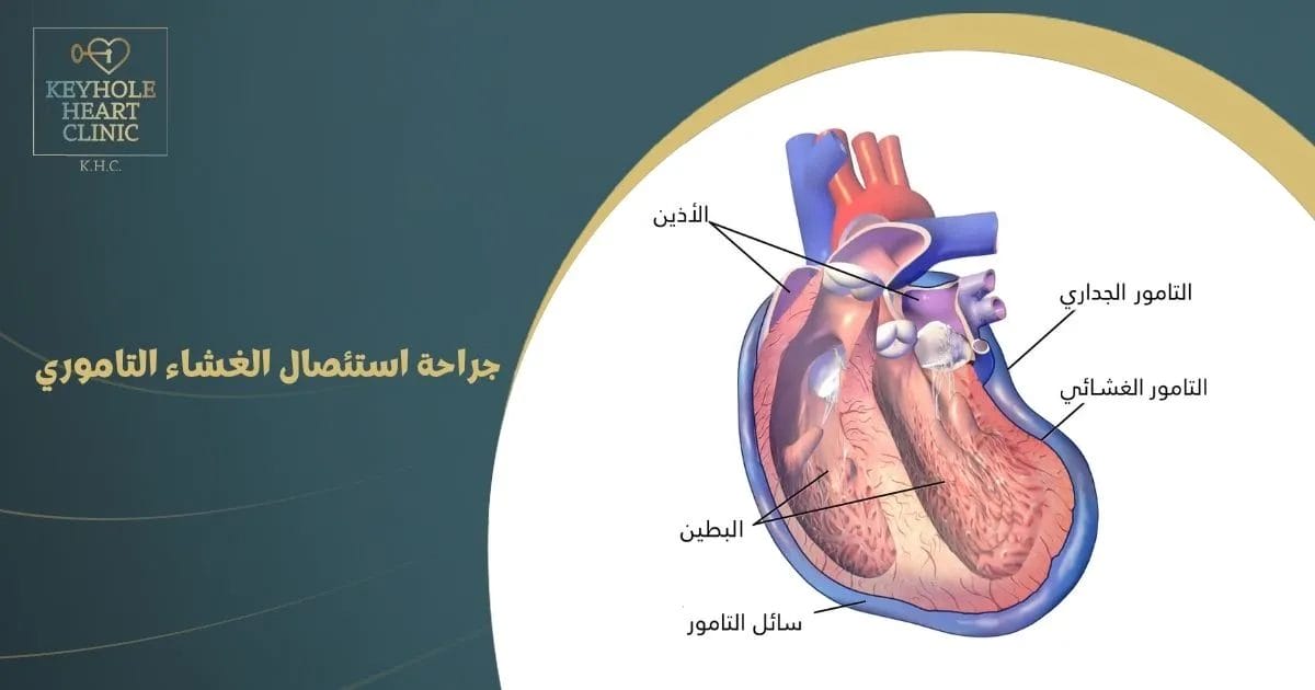 جراحة استئصال الغشاء التاموري