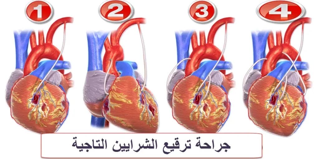 عملية ترقيع الشرايين التاجية