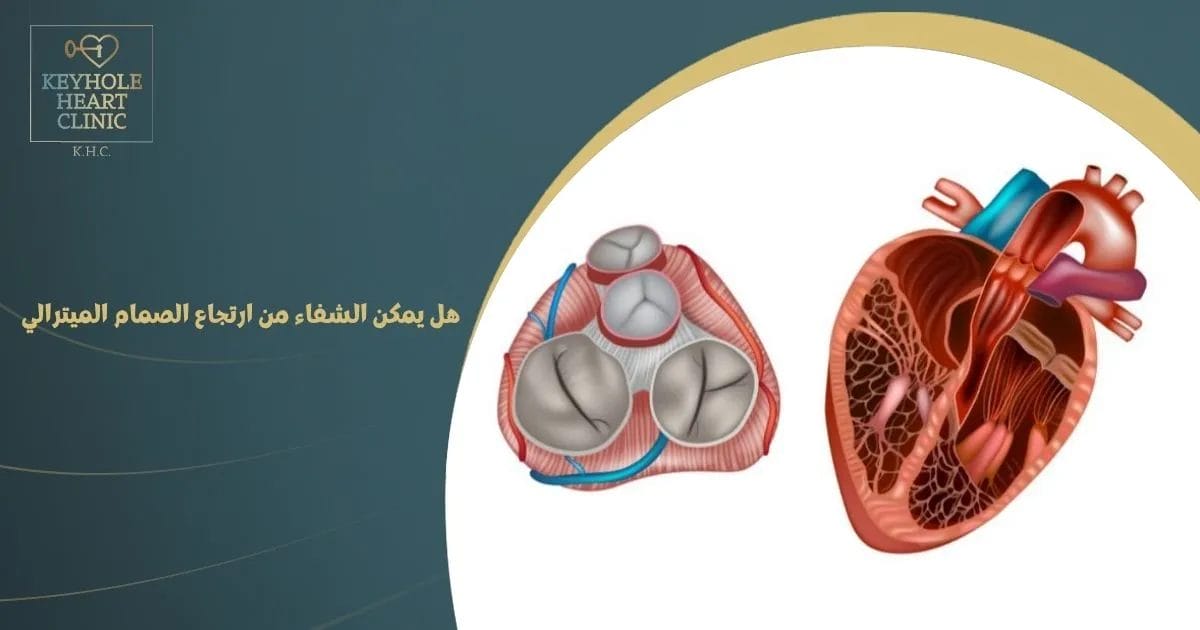 هل يمكن الشفاء من ارتجاع الصمام الميترالي