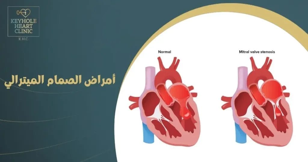أمراض الصمام الميترالي