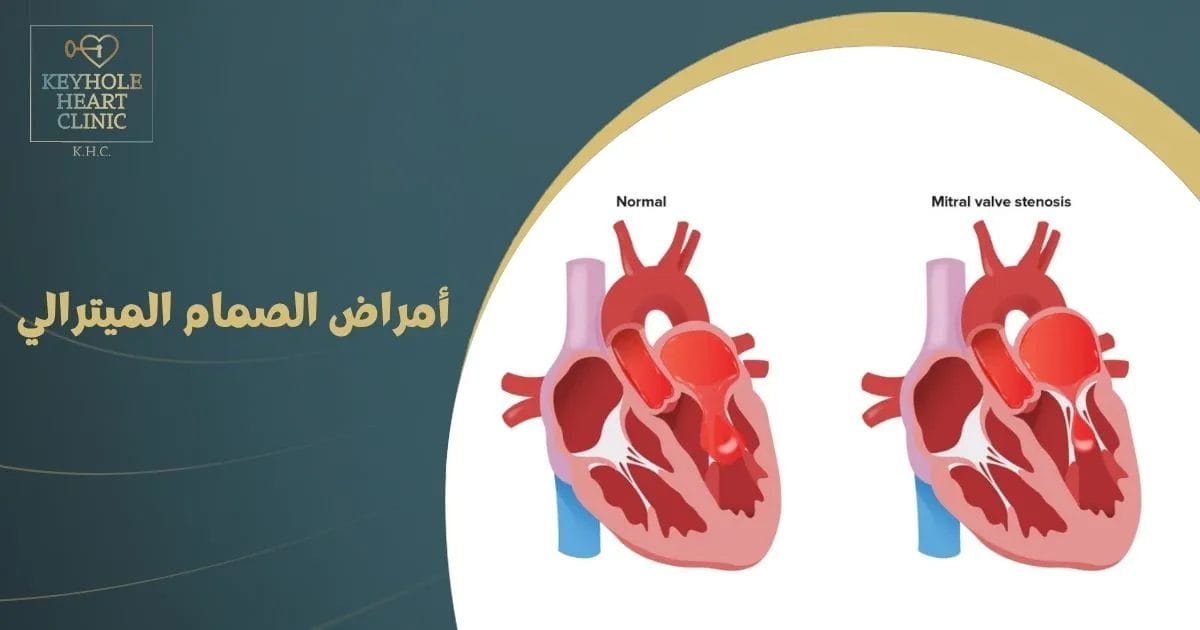 أمراض الصمام الميترالي
