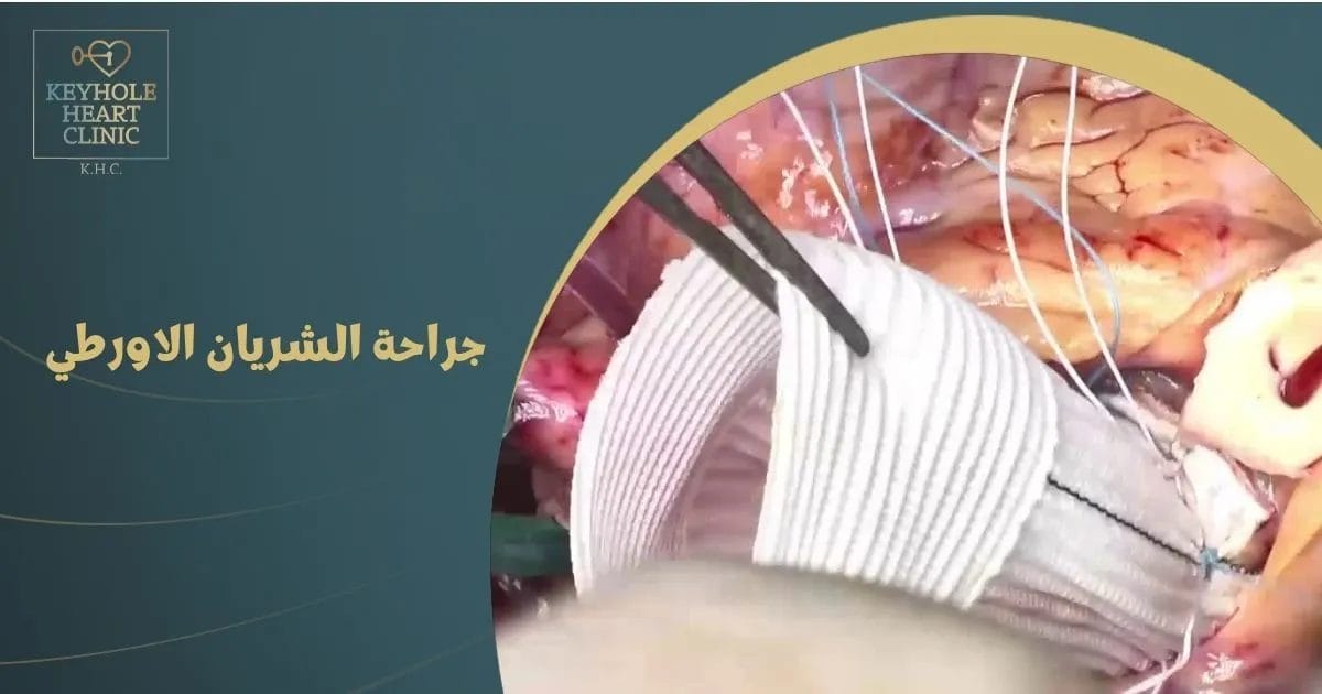 جراحة الشريان الاورطي