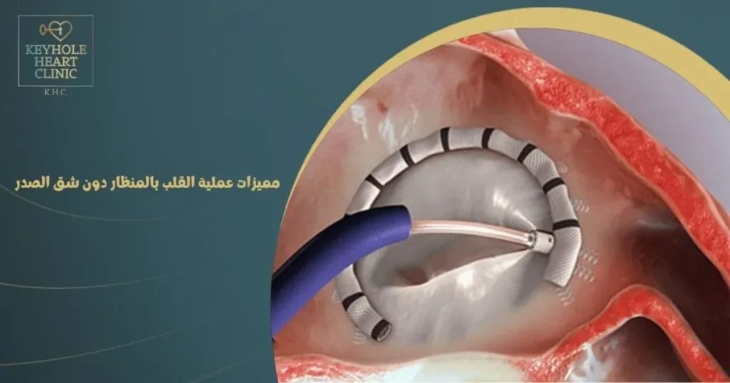 مميزات عملية القلب بالمنظار دون شق الصدر