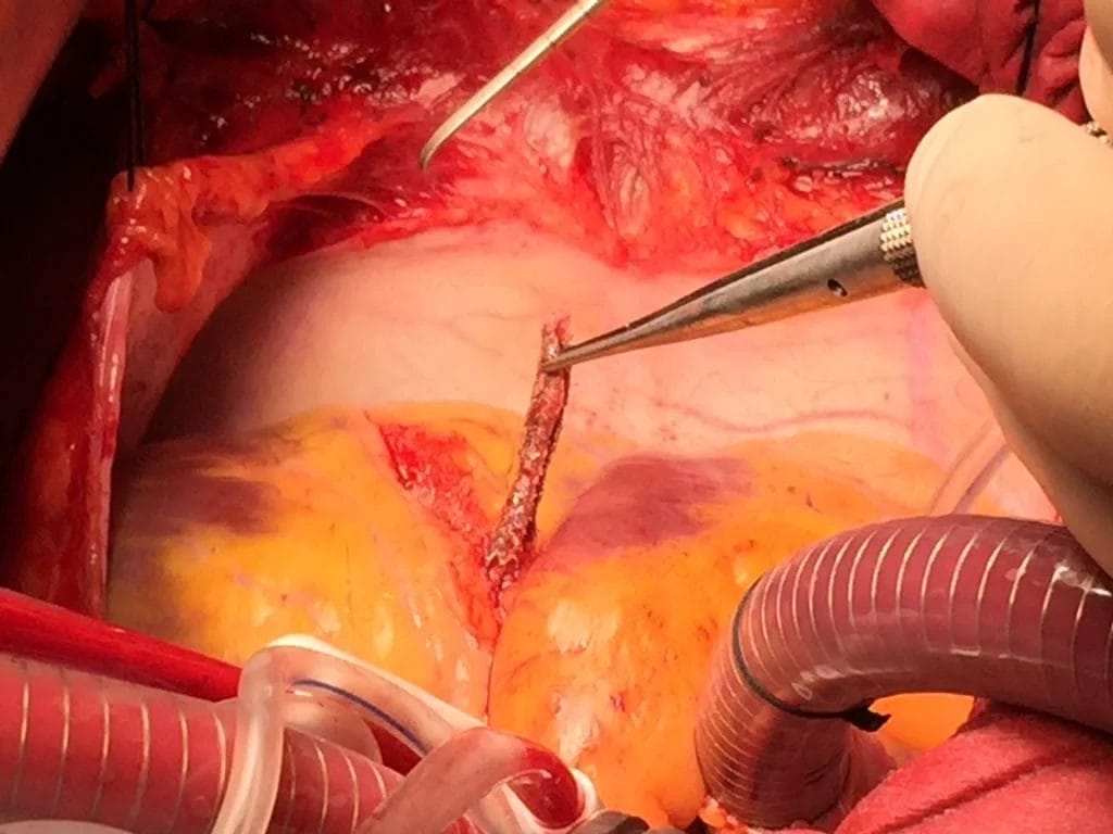 الآثار الجانبية بعد عملية القسطرة