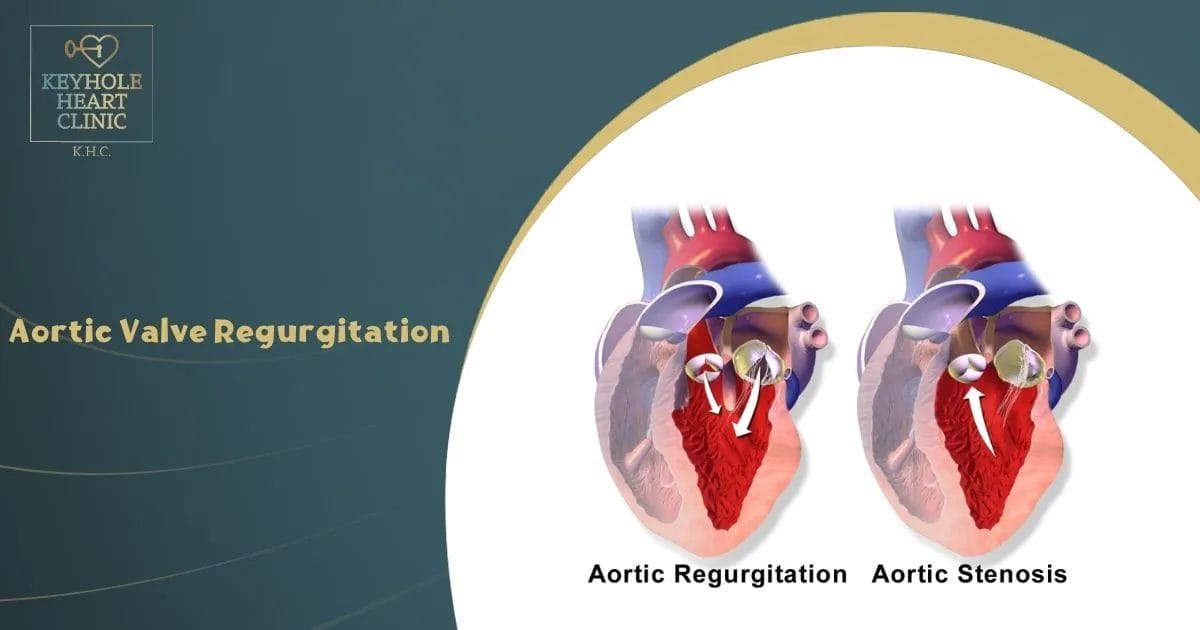 Aortic Valve Regurgitation