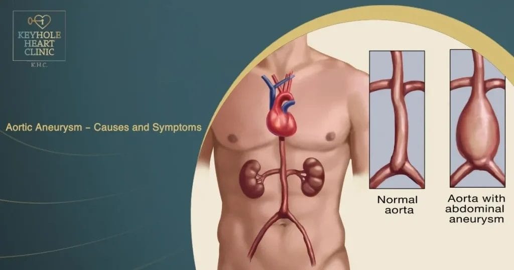Aortic Aneurysm - Causes and Symptoms