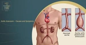 Aortic Aneurysm - Causes and Symptoms