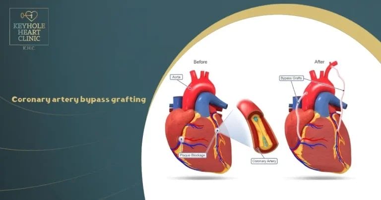 Coronary artery bypass grafting