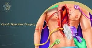 Cost Of Open Heart Surgery | Dr. Muhammad Al-Ghannam