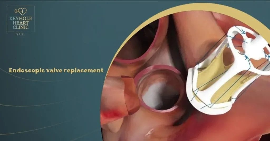  Endoscopic valve replacement