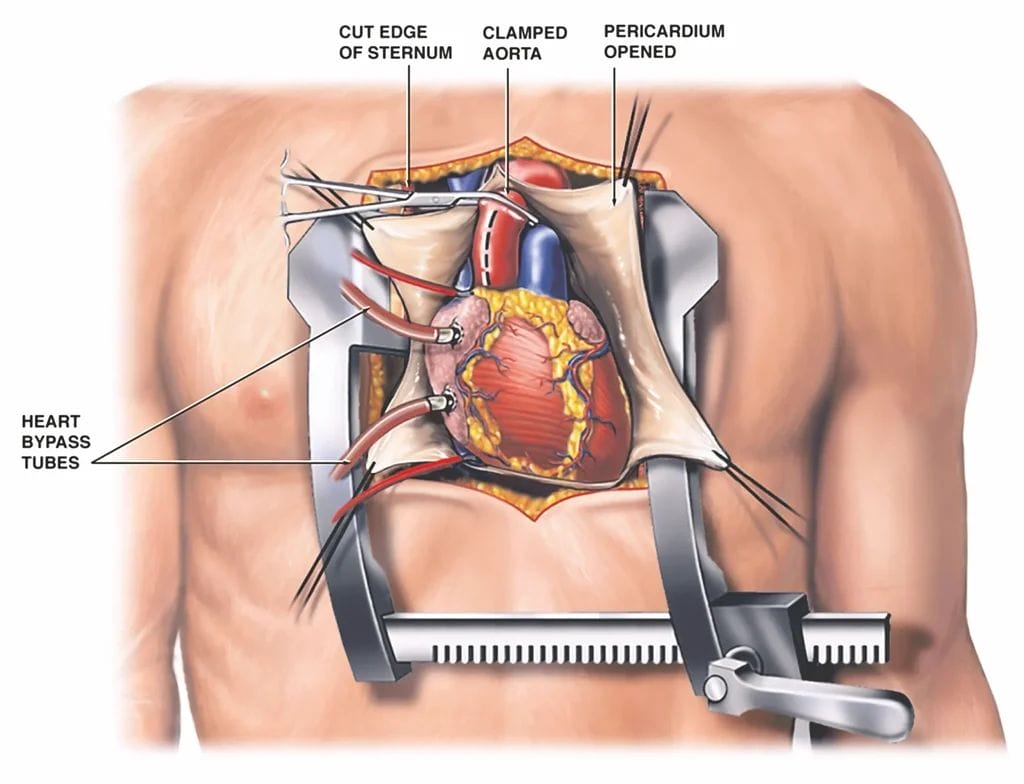 open heart surgery recovery time
