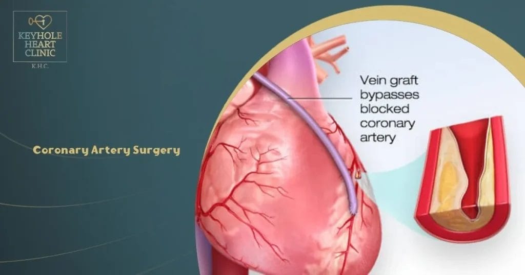 Coronary Artery Surgery