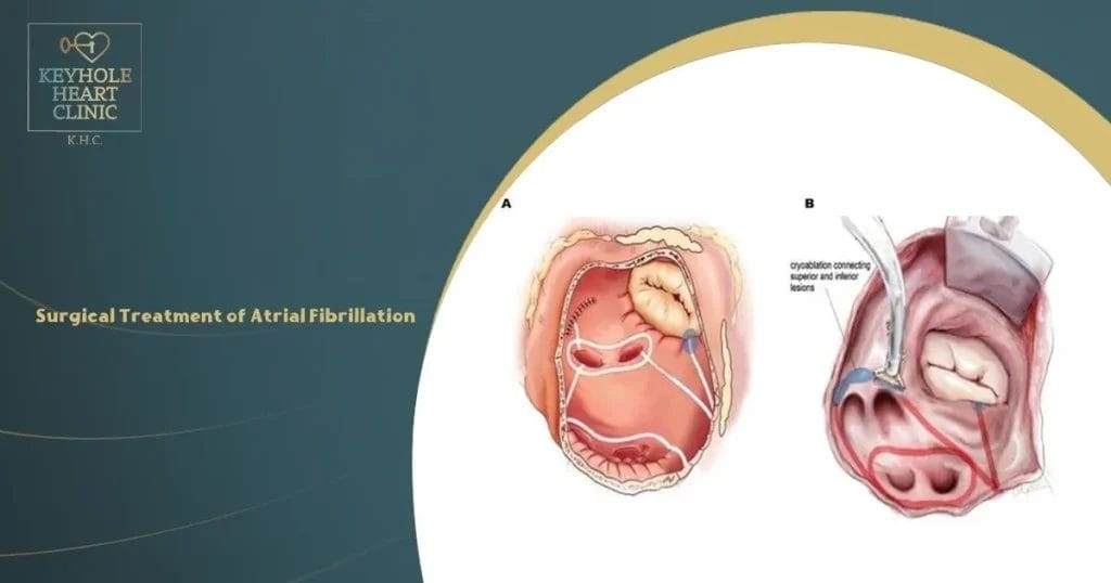 Surgical Treatment of Atrial Fibrillation