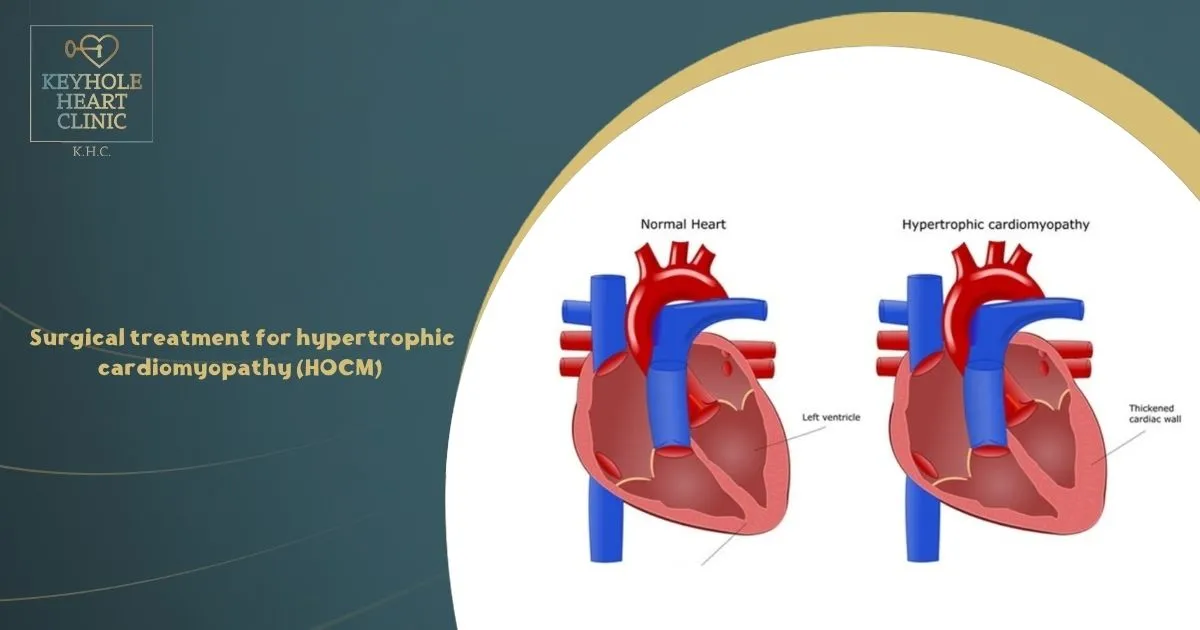 Surgical treatment for hypertrophic cardiomyopathy (HOCM)