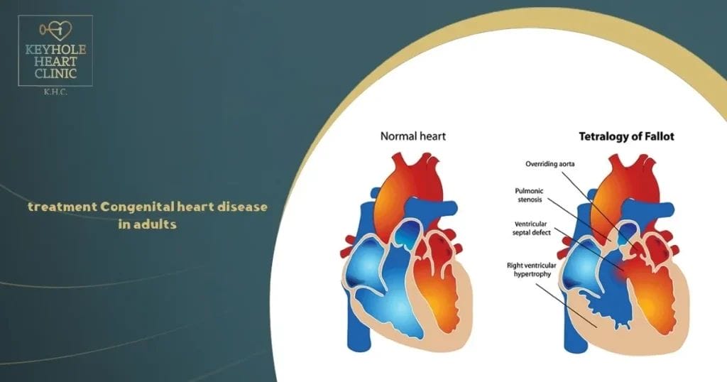 treatment Congenital heart disease in adults