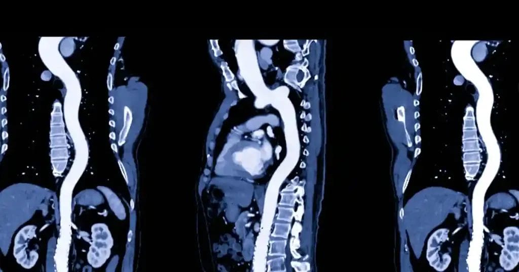 أعراض توسع الشريان الأبهر

