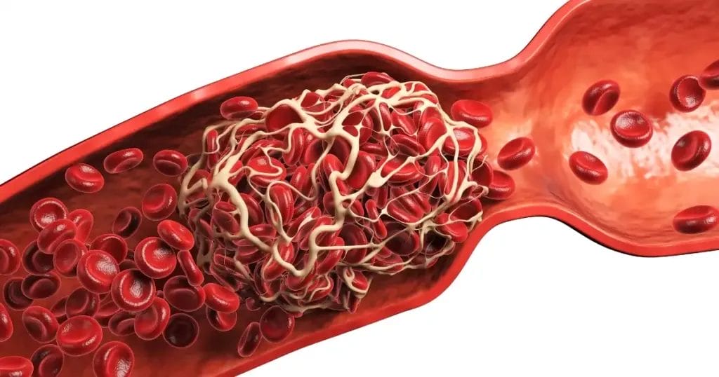 أعراض الورم الحميد في القلب