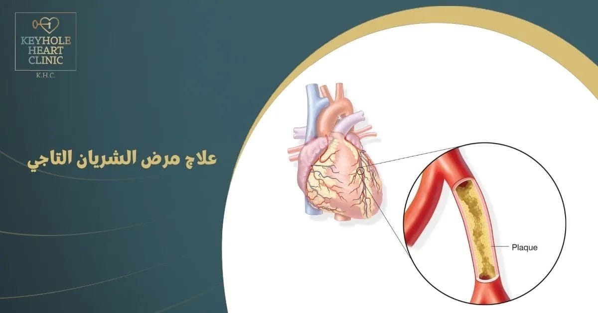 علاج مرض الشريان التاجي