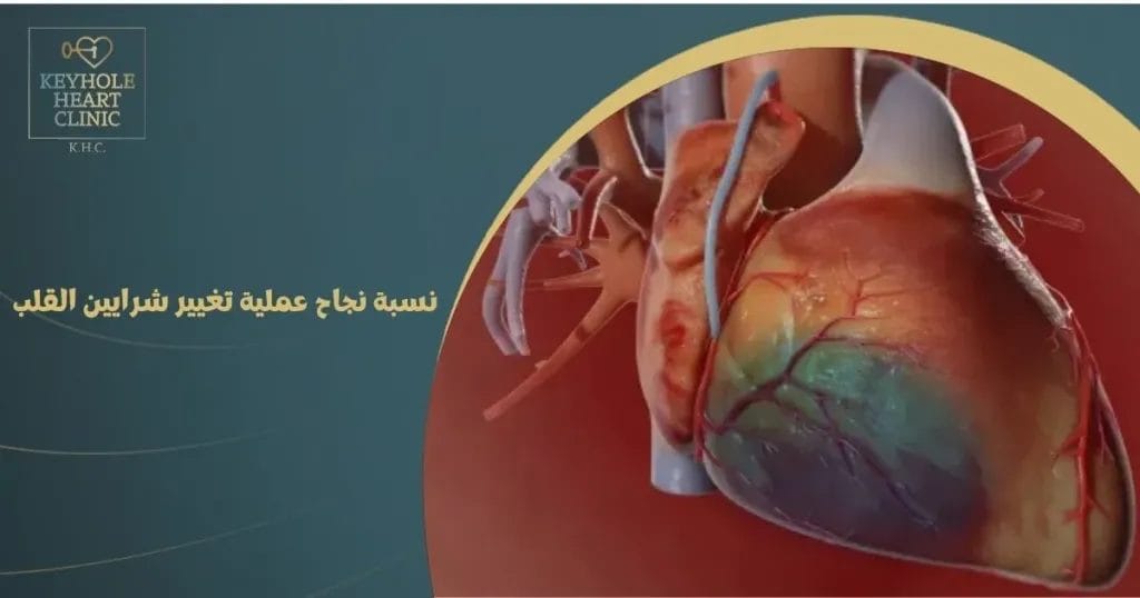نسبة نجاح عملية تغيير شرايين القلب
