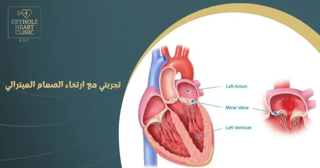 تجربتي مع ارتخاء الصمام الميترالي