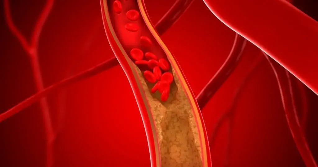 مضاعفات عملية الشريان الأورطي
