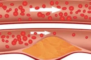 تصلب الشرايين بالصور