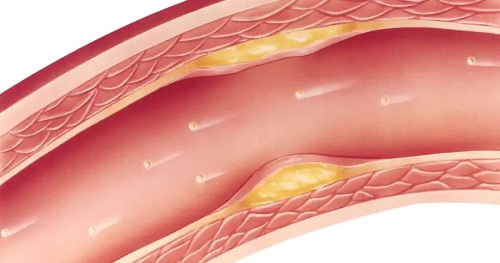 أسباب ارتجاع الصمام الميترالي البسيط