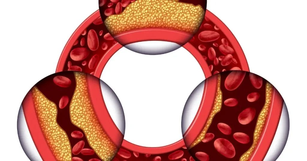 نسبة نجاح عملية توسيع شرايين القلب