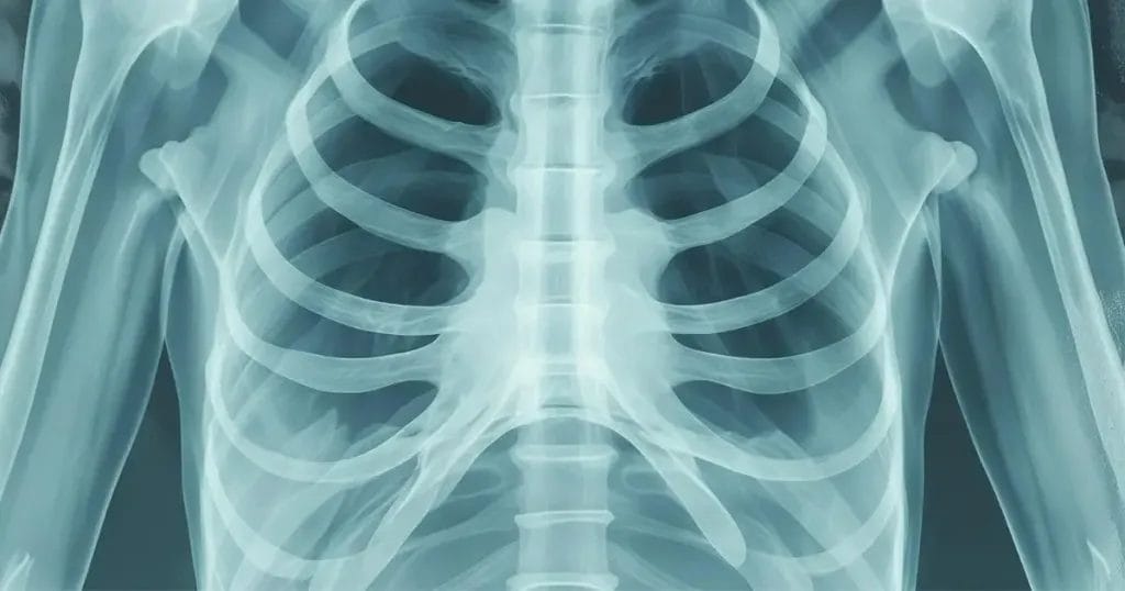 التهاب عظمة القص بعد عملية القلب المفتوح