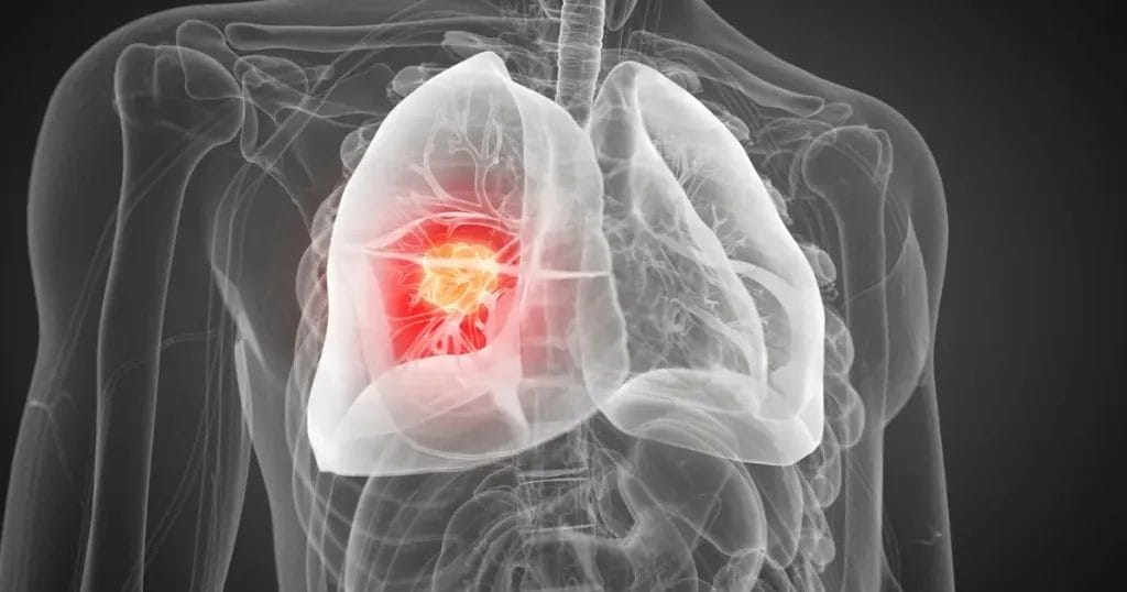 انفجار الشريان الأورطي