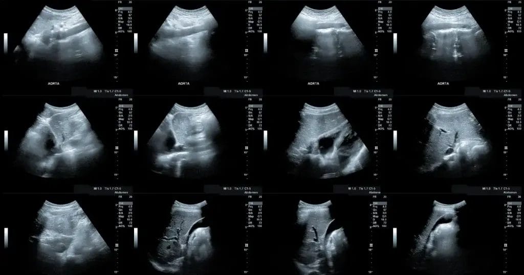 الفرق بين أعراض انفجار الشريان الأورطي الصدري والبطني