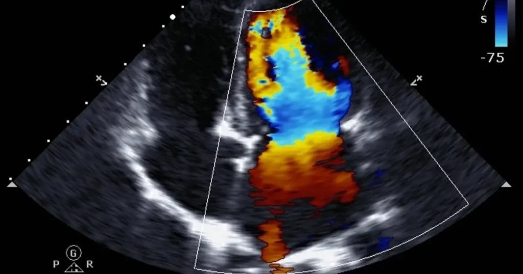 هل رسم القلب بالمجهود يوضح مشاكل القلب