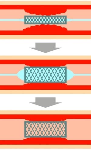 أنواع دعامات القلب