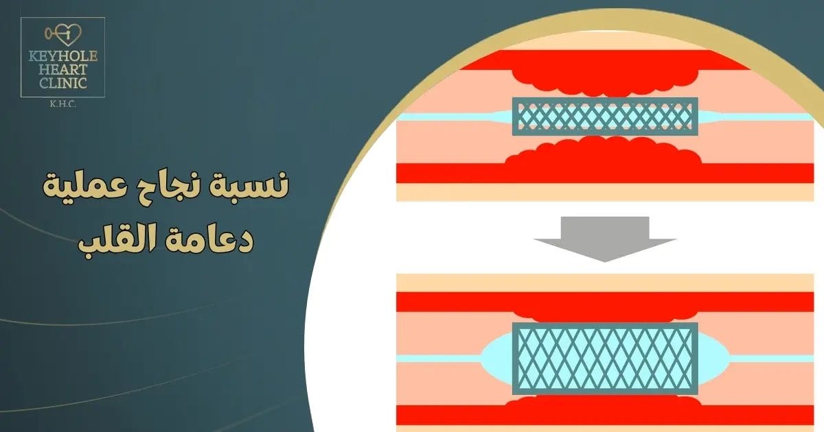 نسبة نجاح عملية دعامة القلب